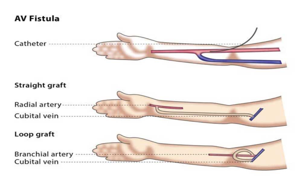 Beyond the Basics Understanding the AVF Varano’s Features