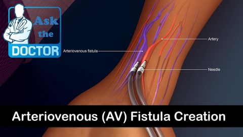 Arteriovenous (Av) Fistula Creation - Youtube throughout Beyond the Basics Understanding the AVF Varano's Features