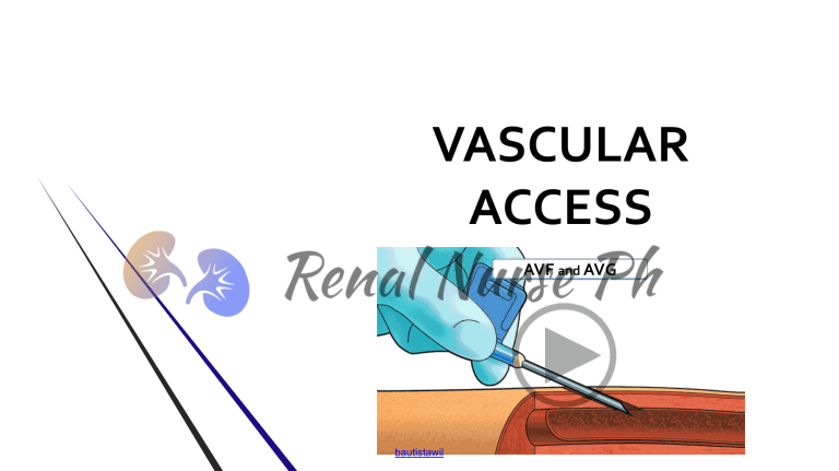 Avf throughout Beyond the Basics Understanding the AVF Varano's Features