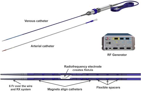 Endovascular Avf Creation – A Neat Option – Ajkd Blog with regard to Beyond the Basics Understanding the AVF Varano's Features