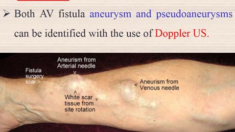 Fistula (Arteriovenous Fistula -Avf) - Youtube with Beyond the Basics Understanding the AVF Varano's Features