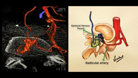 Spinal Dural Arteriovenous Fistula Embolization - Youtube in Beyond the Basics Understanding the AVF Varano's Features